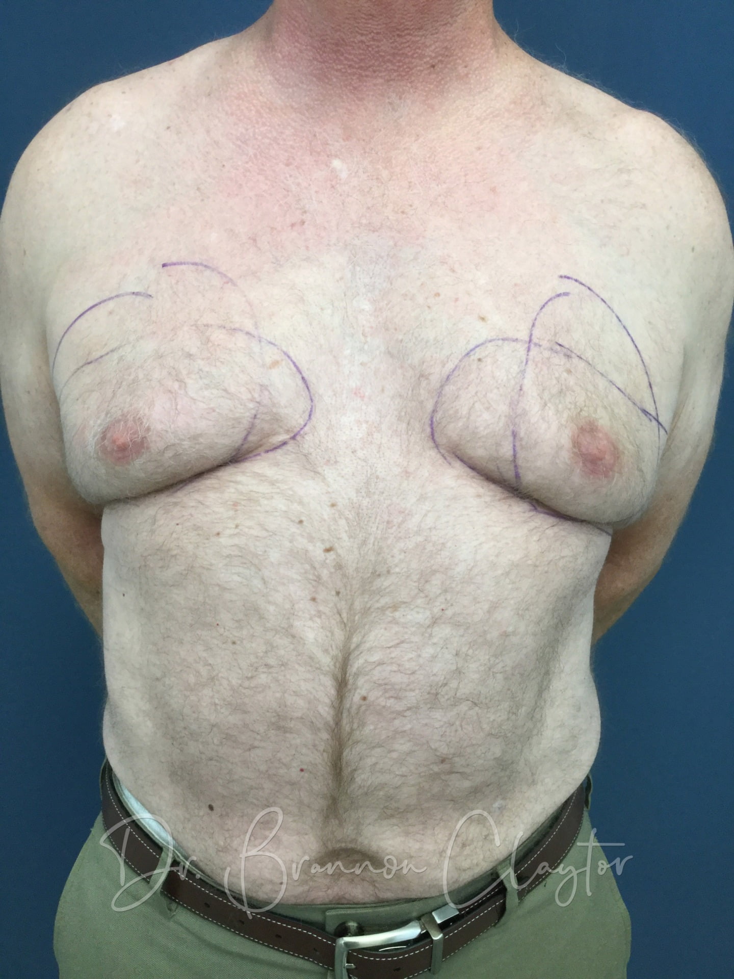 male breast reduction before photo