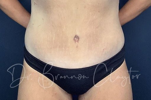 massive-weight-loss-tummy-tuck-breast-lift-implants-48173a-cropped-after